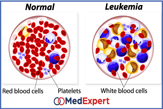 Leukemia: Blood Cancer and Hope for the Future